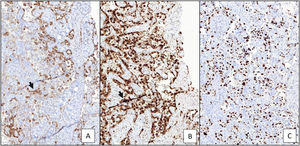 Perfil inmunohistoquímico de la lesión: A) Expresión intensa y difusa de CD31 (200x) (→ tinción de coloración marrón). B) Expresión intensa y difusa de CKAE1/AE3 (200x) (→ tinción de coloración marrón). C) Índice de proliferación celular (Ki67) superior al 40% (200×).