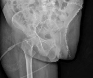 Imagen radiológica posterior a la cirugía de hemipelvectomía externa.