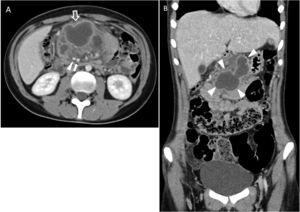 TC abdominal con contraste endovenoso, adquiriéndose las imágenes en fase portal. A) Corte axial. Se objetiva una lesión polilobulada de contenido líquido, que se extiende por el mesenterio, por delante de la arteria (triángulo blanco) y la vena mesentéricas superiores (flecha blanca), que condiciona efecto de masa, separando las estructuras vecinas (duodeno y asas intestinales). Las paredes de su borde antero-inferior muestran marcado realce y se objetiva un aumento de la trabeculación de la grasa mesentérica adyacente (flecha gris de contorno blanco), que sugiere abscesificación. B) Corte coronal. La lesión mesentérica presenta unos contornos lobulados de paredes bien definidas (enmarcada por triángulos blancos).