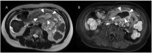 RM de hemiabdomen superior (cortes axiales). A) Secuencia potenciada en T2 en la que se observa una lesión polilobulada e hiperintesa, que se extiende por el mesenterio (enmarcada por flechas blancas). B) Secuencia potenciada en T1 con contraste endovenoso extracelular (gadolinio), donde se objetiva la lesión anteriormente descrita con paredes bien definidas e hipercaptantes. Los hallazgos muestran una lesión de contenido líquido de paredes bien delimitadas que realzan tras la administración de contraste.