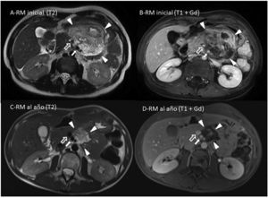 RM tras 2 años y medio de seguimiento. Se muestran 4 imágenes de RM del hemiabdomen superior, (cortes axiales) para valoración comparativa de la lesión quística polilobulada que se extiende por la raíz mesentérica, en el periodo de un año. A y C) RM potenciada en T2. B y D) RM potenciada en T1 con contraste endovenoso extracelular (gadolinio). La localización mesentérica de la lesión se determina por su relación con la arteria mesentérica superior (flecha gris con borde blanco) y la vena mesentérica superior (flecha blanca). La valoración comparativa muestra una franca disminución del tamaño de la lesión (enmarcada por triángulos blancos) y la resolución de la hipercaptación de las paredes que la limitan.