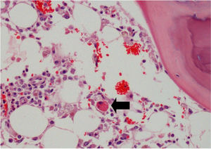 Hemofagocitosis en la médula ósea (flecha) (400×).