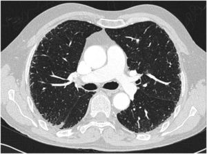 Tomografía axial computarizada pulmonar que muestra el patrón de afectación pulmonar intersticial consistente en reticulación y engrosamiento septales y subpleurales bilaterales de predominio en los campos medios con zonas de panalización y bronquiectasias.