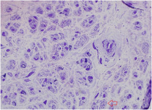 Anatomía patológica del segmento de la biopsia del nervio sural con tinción de azul de toluidina. Se objetivan signos de mielinización y desmielinización. Se señala con una flecha roja una imagen compatible con el bulbo de cebolla.