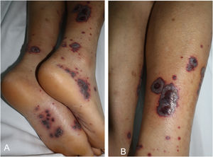 Purpuric lesions on the lower limbs.