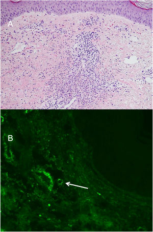A: Histological image HE x5, small base leukocytoclastic vasculitis in superficialreticular and papilar dermis. B: Direct immunofluorescence testing for IgA, perivascular IgA deposits (white arrow).