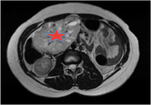 Estudio de localización: RMN abdominal. TAC T-A con contrase que evidencia gran masa de origen retroperitoneal, de 11 x 8 x 7 cm, compatible con paraganglioma paraórtico derecho. La lesión está altamente vascularizada, con vasos arteriales y venosos de gran calibre en su interior.