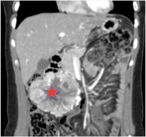 Estudio de extensión con TAC toracoabdominal con contraste. RMN abdominal T2 que visualiza una gran masa abdominal de 6,8 x 10,9 x 8,3 cm (AP x T x L), que condiciona efecto masa con compresión de la vena cava inferior y desplazamiento de asas intestinales.