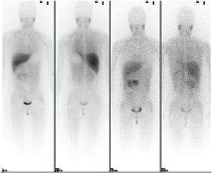 Estudio gammagráfico con MIB 131. Estudio de extensión con MIBG 131. Se observa captación fisiológica en hígado y salivares y eliminación urinaria. En el área cardiaca existe una actividad muy tenue e irregular, en probable relación con el exceso de catecolaminas. Se objetiva presencia de receptores adrenérgicos en la masa abdominal conocida.
