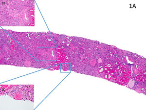 A) Se muestra una imagen panorámica de la biopsia renal, en la que se aprecia una grave fibrosis. B) Algunas de las arteriolas mostraron hialinización intensa. C) Otras dos arteriolas mostraron presencia de trombos luminales.