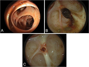 (A) Multiple sigmoid diverticulae with signs of subacute hemorrhage. (B) Adherent clot within one diverticulum repesenting the culprit lesion. (C) Visible vessel after clot detachment, subsequently provided with two hemoclips.