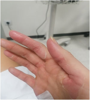Descamación palmar.