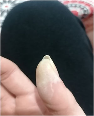 Tejido desvitalizado previo a la descamación.