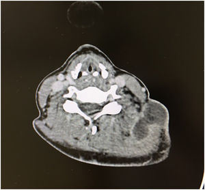 Colección en la región laterocervical inferior izquierda, espacio V, que desciende posterior al músculo esternocleidomastoideo con afectación del hueco supraclavicular izquierdo, hueco infraclavicular hasta llegar a la región axilar izquierda.