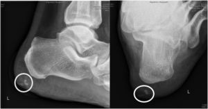 Radiografía simple en proyección lateral y posteroanterior del talón izquierdo del paciente, donde se observa una calcificación subcutánea, con la presencia de un leiomioma dérmico.