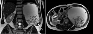 Vista coronal y axial de la resonancia magnética abdominal que muestra una lesión quística con dependencia del riñón izquierdo.