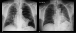 Chest radiograph: a) Admission - left pneumothorax and atelectasis; b) 5 days later - chest tube placed on the left hemithorax with partial pulmonary expansion, persistence of small pneumothorax, atelectasis and signs of subcutaneous emphysema.