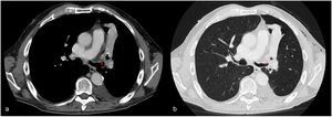 Chest CT (axial images, mediastinal (a) and lung (b) window): Left hydropneumothorax with atelectasis of the left upper lobe. A rounded shape foreign body is obstructing the left upper lobe bronchus (arrow).
