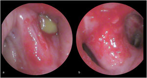 Videobronchoscopy photographs at secondary carina of the left main bronchus: a) first evaluation - total obstruction of the left upper lobe bronchus by a green pea, oedema and hyperaemia of the adjacent mucosa; b) reavaluation - patency of lobar and segmental bronchi, with enlargement of secondary carina by oedema of the mucosa.