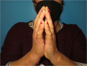 Incapacidad para aproximar la superficie palmar de ambas manos, conocida como signo del orador.