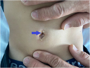 Ombligo con granuloma y meato con exudado antes de iniciar tratamiento antibiótico. Umbilical granuloma and exudative meatus before antibiotics were initiated.