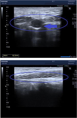 A: Ecografía abdominal: Nódulo subcutáneo hipoecogénico de 18 mm de diámetro. Abdominal ultrasound: Hypoechogenic subcutaneous 18 mm-diameter nodule. B: Ecografía abdominal: Trayecto hipoecogénico que comunica el ombligo con la vejiga. Abdominal ultrasound: Hypoechogenic tract that connects the umbilicus to the bladder.