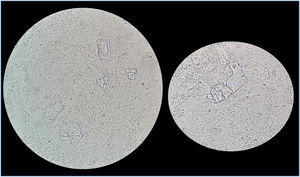 Optical microscopic observations (40x) of fresh pleural fluid, showing cholesterol crystals on a dirty agranular background.