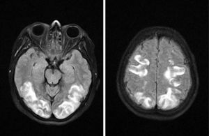 Imagen radiológica por RM en T2 de PRES en fase aguda. Aumento de señal en sustancia blanca subcortical de ambos lóbulos occipitales (A) y regiones superiores de lóbulos parietales (B) de forma bilateral y simétrica, compatible con edema vasogénico.