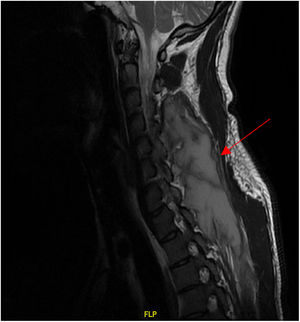 Resonancia cervical.