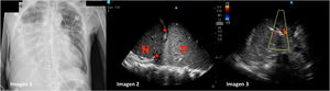 Imagen 1: Radiografía de tórax. Se objetiva opacidad de la práctica totalidad del pulmón derecho. Imagen 2: Hepatización pulmonar (letra P) separado del hígado (letra H) por el diafragma (estrella roja). Imagen 3: Ecografía doppler de pulmón derecho. Se observa broncograma aéreo (flecha roja).
