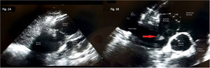 Ecocardiografía. Plano subxifoideo. Se objetiva gran dilatación de cavidades derechas. Se observa trombo en aurícula derecha (flecha roja).