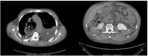 CT scan: Oesophagus distension (arrow) upstream of a stenotic aspect of the esophagogastric junction. Bilateral pleural effusion of moderate size (asterisk on the left image) and pericardial effusion of small size. Intraperitoneal effusion of moderate abundance and mesenteric fat densification. Bilateral pyelocaliceal dilatation (asterisk on the right image) without detectable lithiasis.