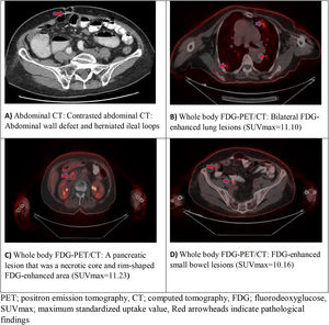 Radiologic images of the patient PET; positron emission tomography, CT; computed tomography, FDG; fluorodeoxyglucose, SUVmax; maximum standardized uptake value, Red arrowheads indicate pathological findings
