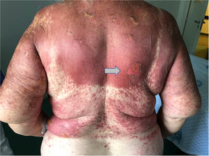 Dorsal area involvement. Coalescent macular erythematous skin lesions with ruptured blister (arrow).