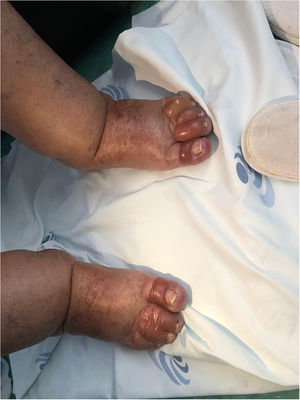 Patient feet with bulky blisters in its toes.