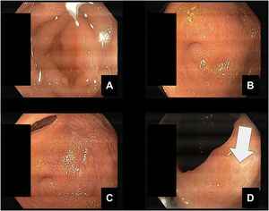 Colonoscopy performed with adequate bowel preparation. Biopsies were made in the right and left colon (D).