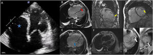 Principal findings of echocardiography and cardic magnetic resonance.