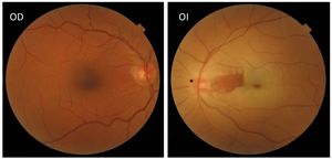 Retinografía de ambos ojos. La retinografía del ojo derecho (OD) no muestra cambios patológicos. Sin embargo, la del ojo izquierdo, muestra una palidez mancha roja cereza, pero con conservación de la irrigación en una zona nasal, correspondiente a una arteria cilioretiniana permeable. Además, se aprecia un leve edema papilar (*).