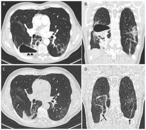Chest Angio-CT. Thin-walled cystic lesion with an air-fluid level (arrowheads) (A) and consolidations in lower lobes (B). Chest Angio-CT performed eight weeks later showed complete resolution of the pneumatocele (C) with persisting subpleural and parenchymal bands (arrows) (D).