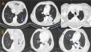 A CT scan at the start of the lung mass study in case 1. A non-specific nodule of 1 cm in diameter is seen in the left lung base (first image) and a mass in the apicoposterior segment of the left upper lobe measuring 6.47 × 5.07 cm (central image). Fig. 1B CT scan on admission in case 1. Two cavitated masses are seen: one in LUL (already known), and a new one in LLL with a liquid component.