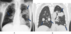 Pulmonary metastasis on chest X-ray and CT-Scan.