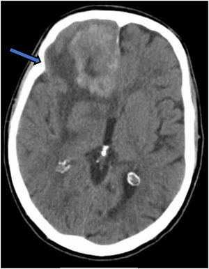Frontal metastasis on brain CT-Scan.