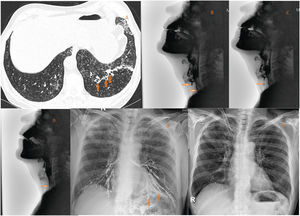 A. HRCT, axial image: Cylindrical bronchiectasis (arrows) and a patchy infiltrate in the left lower lobe are seen. Multiple micronodules suggestive of cellular bronchiolitis are noted in the lower lobes, especially in the left lung. B--D. VFSS. The patient tilts his head upwards to attempt swallowing. Tracheal aspiration of barium sulfate is evident (arrows). E. Chest x ray obtained the same day shows accidental bronchography caused by aspiration of barium. The arrows point to the bronchiectasis. F. Follow-up chest x ray within 1 week shows clearance of the barium in the airway.