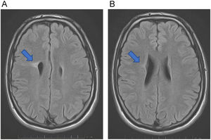 A and 1B: T2 FLAIR MRI revealing dyplastic cortex and right lateral ventricle wall umbilication.
