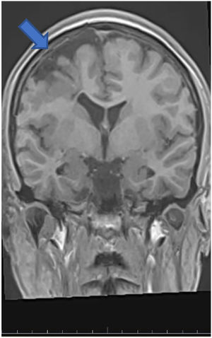 T1 MPR batch coronal right frontal cortex dysplasia.