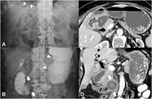 A: Conventional X-ray of the abdomen shows pneumobilia (white arrowheads). B: Oral contrast-enhanced X-ray shows distension of the gastric chamber (white arrowheads), contrast-filling of the gallbladder (asterisk) and a filling defect in the third portion of the duodenum (white arrows). C & D: Contrast-enhanced CT shows a cholecystoduodenal fistula (asterisks), pneumobilia (black arrowheads) and a non-calcified gallstone in the third portion of the duodenum (white arrows).