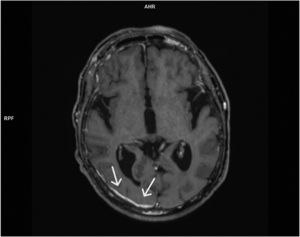 (Arrows) T1-weighted MRI scan showing anomalous pachymeningeal dural enhancement and leptomeningeal involvement on occipital and parietal right lobe.