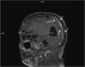 (Arrows): Gadolinium- enhanced axial T1-weighted MRI scan showing anomalous pachymeningeal dural enhancement and leptomeningeal involvement on occipital and parietal right lobe.