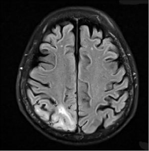 (Arrows): Gadolinium- enhanced axial T1-weighted MRI scan showing rihgt occipito-parietal subcortical edematous component.