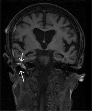 (Arrows) T1-weighted MRI scan showing right otomastoiditis.